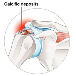 Calcification of rotator cuff