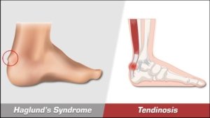 Insertional achilles tendinopathy